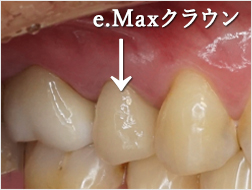 e.maxクラウン