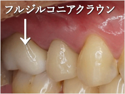 フルジルコニアクラウン