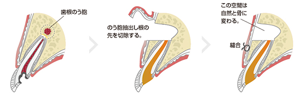 歯根のう胞