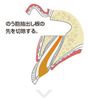 のう胞抽出し根の先を切除する。