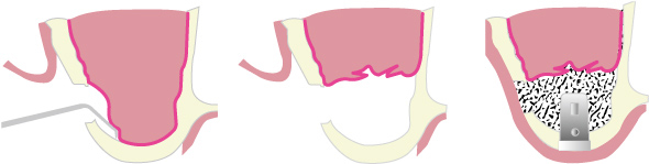 サイナスリフト